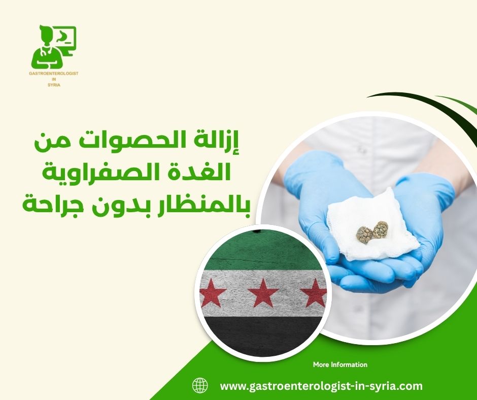 إزالة الحصوات من الغدة الصفراوية بالمنظار بدون جراحة
