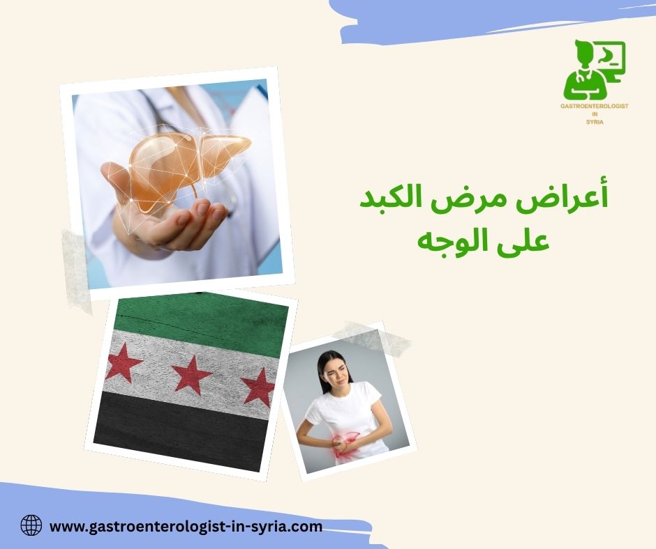 أعراض مرض الكبد على الوجه أعراض مرض الكبد على الوجه